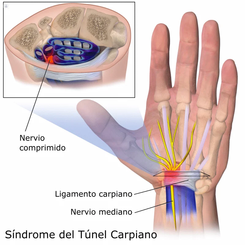 tendones flexores de la muñeca